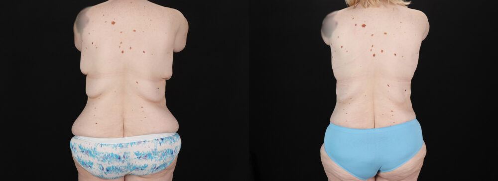 Post Bariatric Surgery (Massive Weight Loss) case #6786