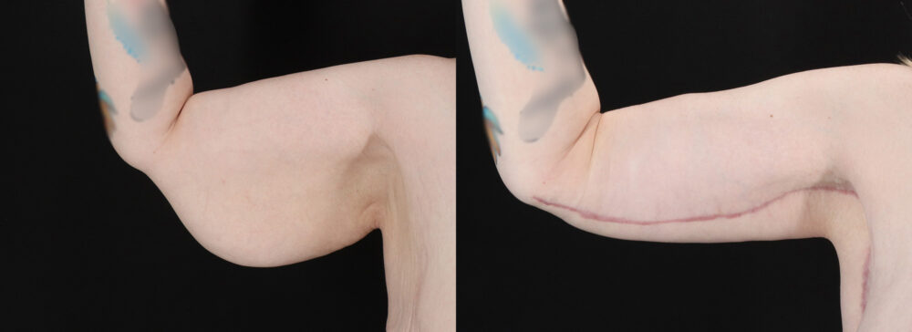 Post Bariatric Surgery (Massive Weight Loss) case #6786