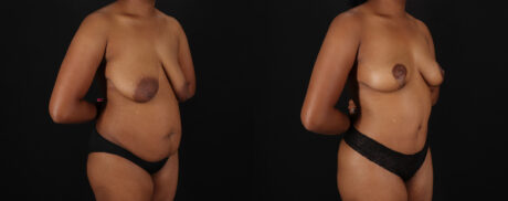 Mommy Makeover case #6689