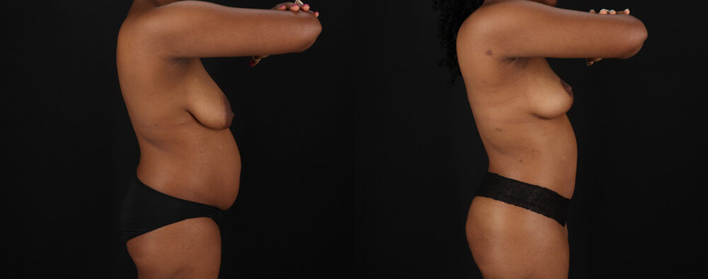 Mommy Makeover case #6689