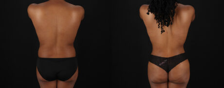 Mommy Makeover case #6689