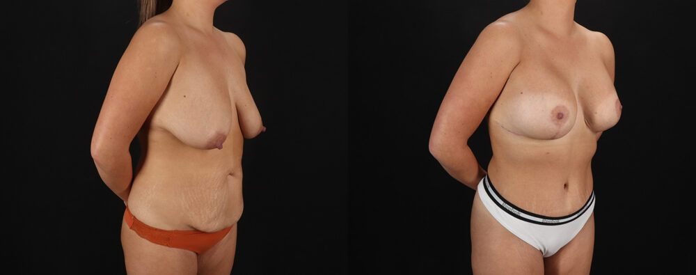 Mommy Makeover case #6690