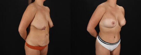 Mommy Makeover case #6690