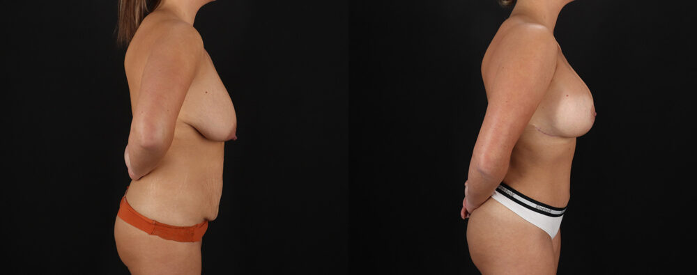 Mommy Makeover case #6690