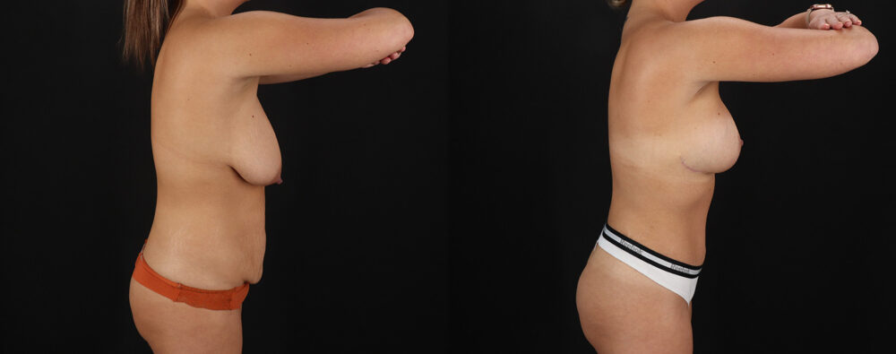 Mommy Makeover case #6690