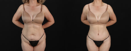 Mommy Makeover case #6767