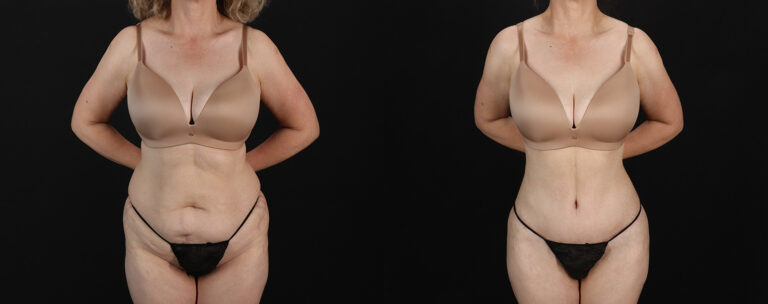 Mommy-Makeover-Before-and-After-Photo-by-Dr.-Erika-A.-Sato-in-Houston-TX-258498-1-768×304