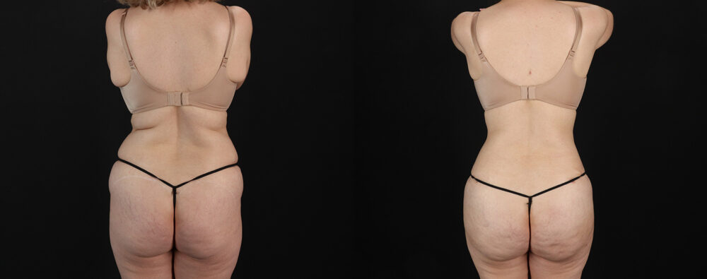 Mommy Makeover case #6767