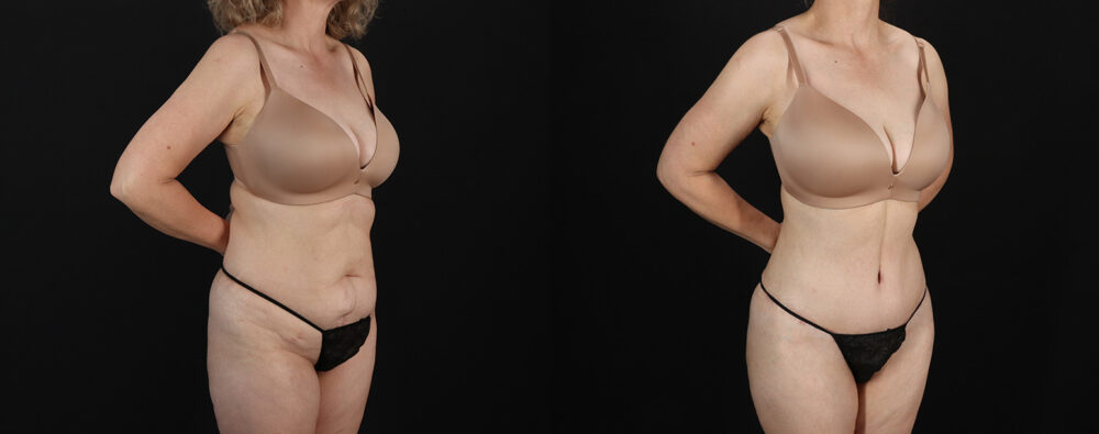 Mommy Makeover case #6767