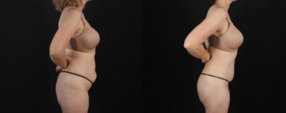 Mommy Makeover case #6767