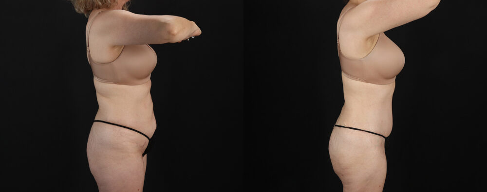 Mommy Makeover case #6767