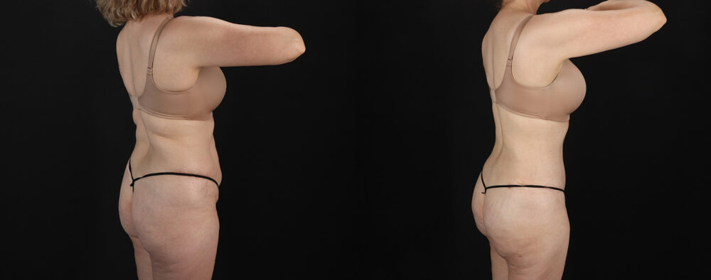 Mommy Makeover case #6767