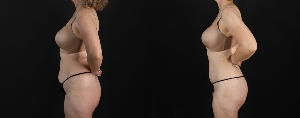 Mommy Makeover case #6767