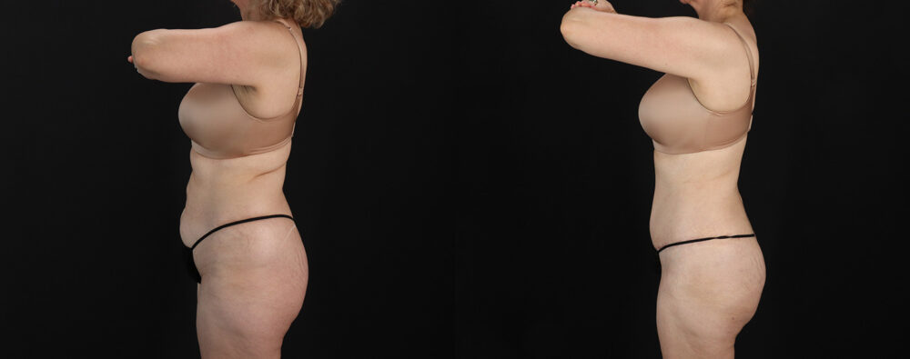 Mommy Makeover case #6767