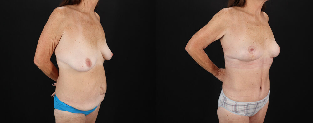 Mommy Makeover case #6691