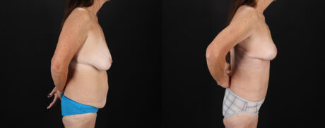 Mommy Makeover case #6691