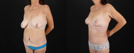 Mommy Makeover case #6691