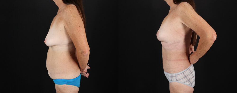 Mommy Makeover case #6691