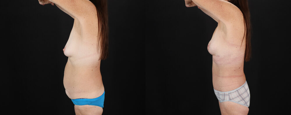 Mommy Makeover case #6691