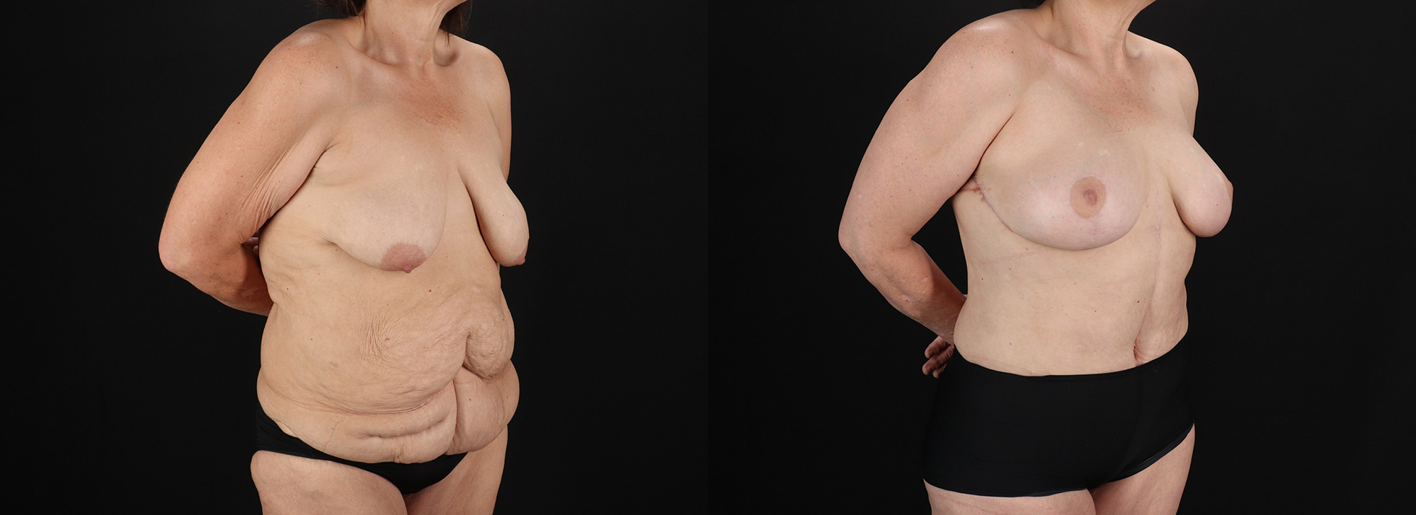 Post-Bariatric-Surgery-Massive-Weight-Loss-Before-and-After-Photo-by-Dr.-Erika-A.-Sato-in-Houston-TX-2of10