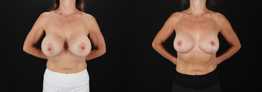 Revision Breast Surgery case #256282