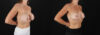 Revision Breast Surgery case #256282 slider thumbnail