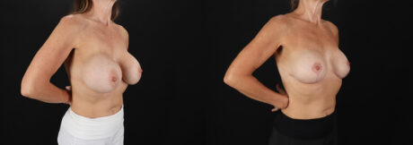 Revision Breast Surgery case #256282