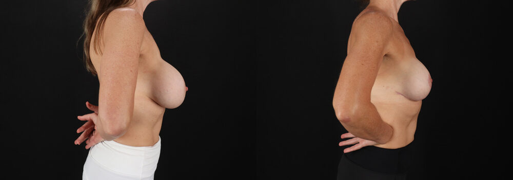 Revision Breast Surgery case #256282