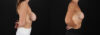 Revision Breast Surgery case #256282 slider thumbnail