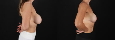 Revision Breast Surgery case #256282