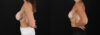 Revision Breast Surgery case #256282 slider thumbnail