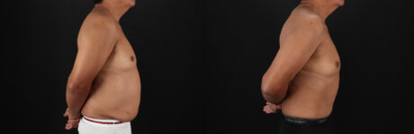 Tummy Tuck case #7623