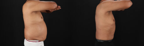 Tummy Tuck case #7623