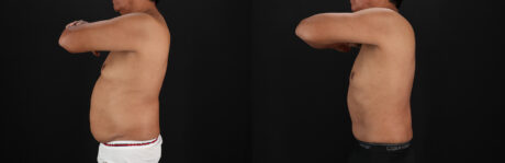 Tummy Tuck case #7623