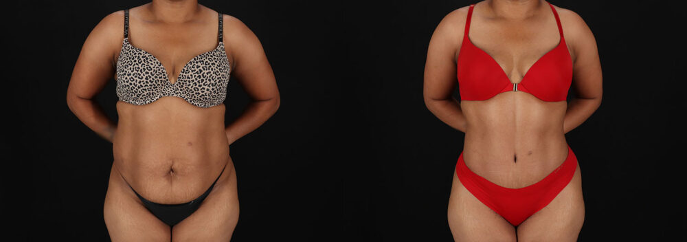 Tummy Tuck case #7777