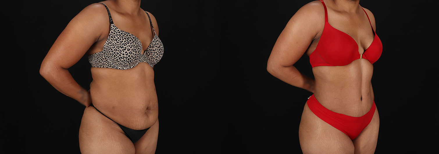Tummy-Tuck-Before-and-After-Photo-by-Dr.-Erika-A.-Sato-in-Houston-TX-258035-2