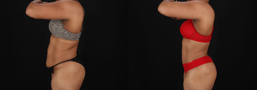 Tummy Tuck case #7777