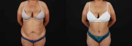 Tummy Tuck case #7778
