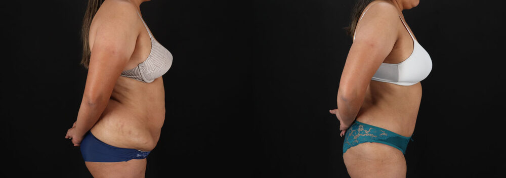 Tummy Tuck case #7778