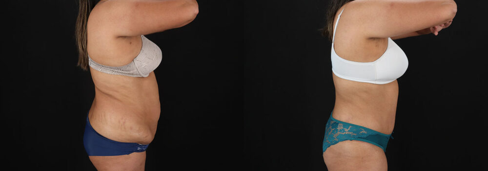 Tummy Tuck case #7778