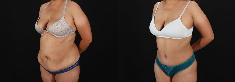 Tummy Tuck case #7778