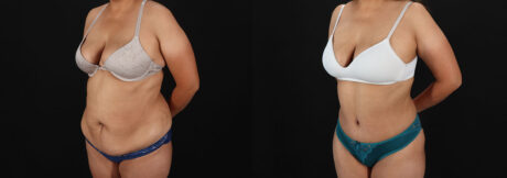 Tummy Tuck case #7778