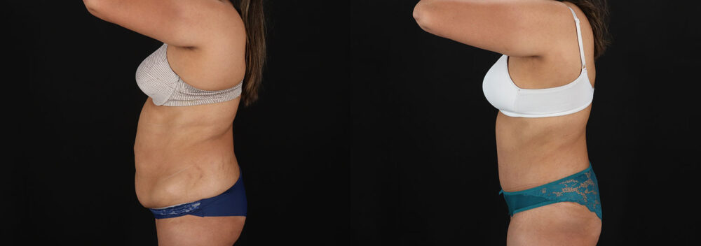 Tummy Tuck case #7778