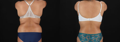 Tummy Tuck case #7778