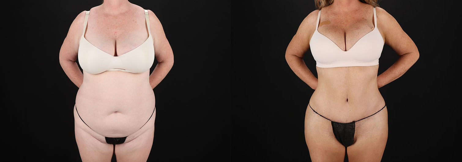 Tummy-Tuck-Before-and-After-Photo-by-Dr.-Erika-A.-Sato-in-Houston-TX-258216-1