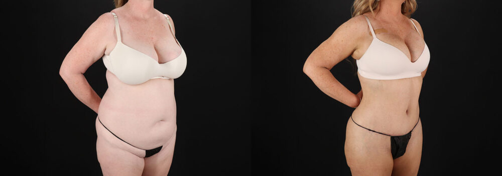 Tummy Tuck case #7779