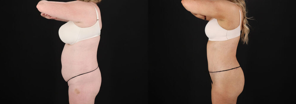 Tummy Tuck case #7779