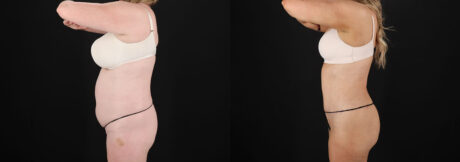 Tummy Tuck case #7779