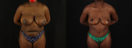 Tummy Tuck case #7780