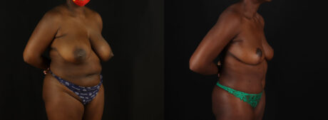 Tummy Tuck case #7780